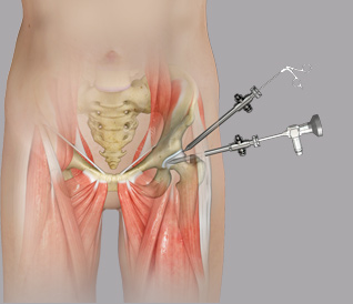 Hip Arthroscopy-Clinical American Hip Institute Research Foundation