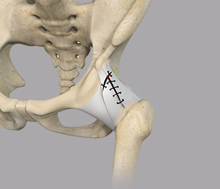 Capsular Repair Versus Capsulotomy American Hip Institute Research Foundation